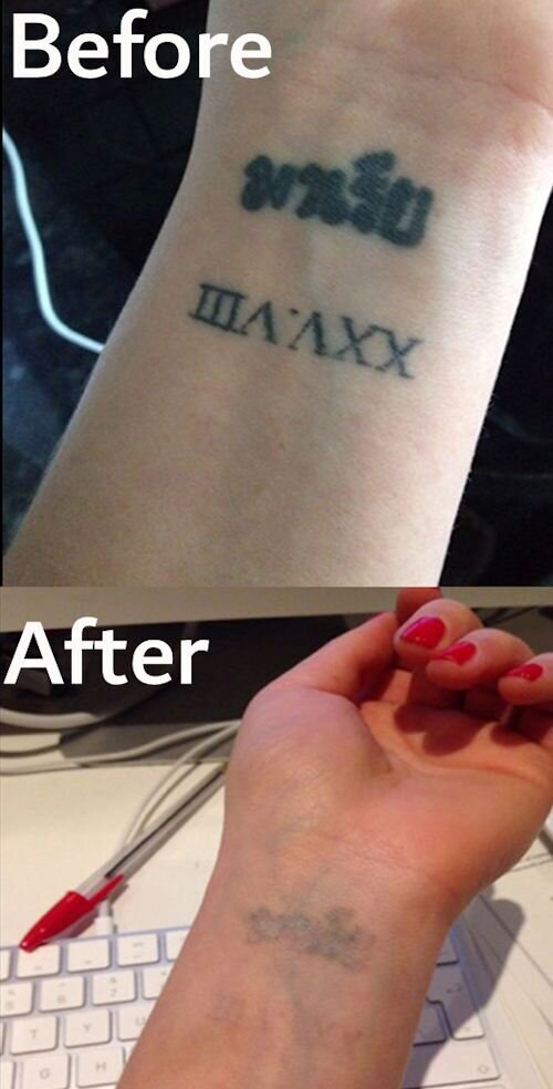 laser removal wrist tattoo,Dublin tattoo removal, laser tattoo removal